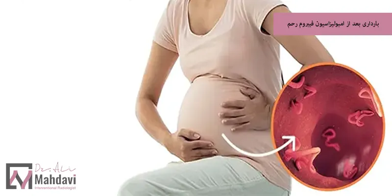 بارداری بعد از امبولیزاسیون فیبروم رحم