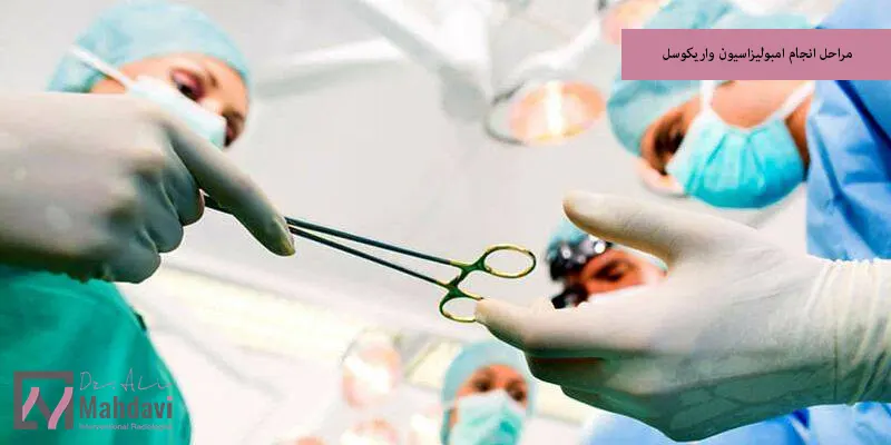 مراحل انجام امبولیزاسیون واریکوسل