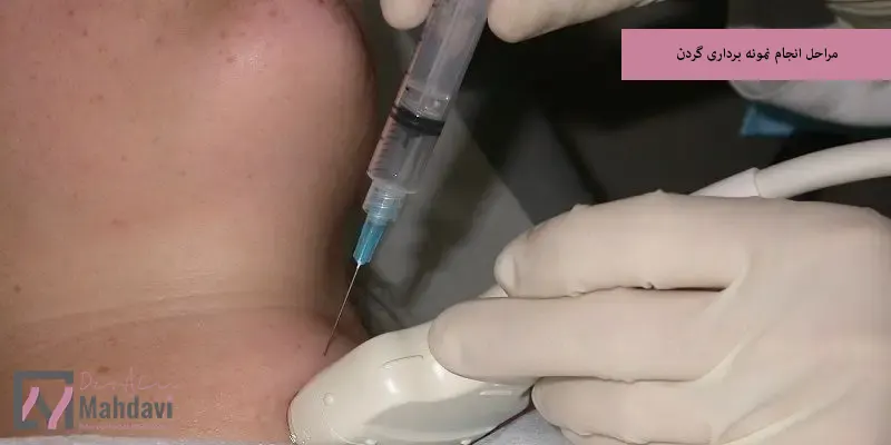مراحل انجام نمونه برداری گردن