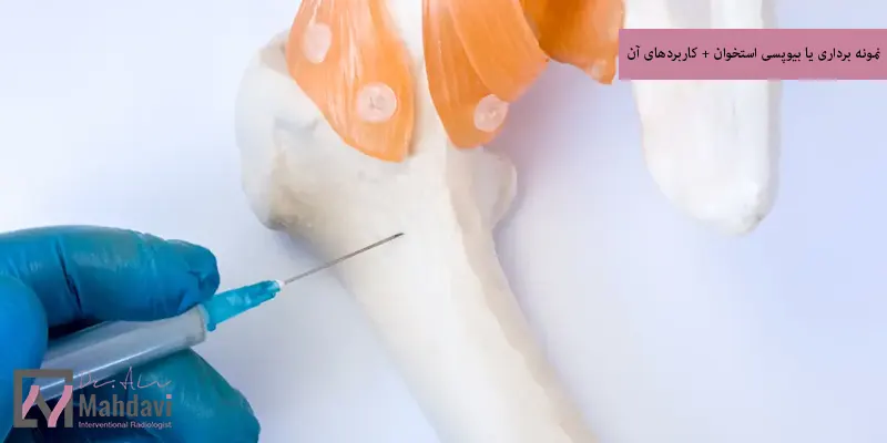 نمونه برداری یا بیوپسی استخوان + کاربردهای آن