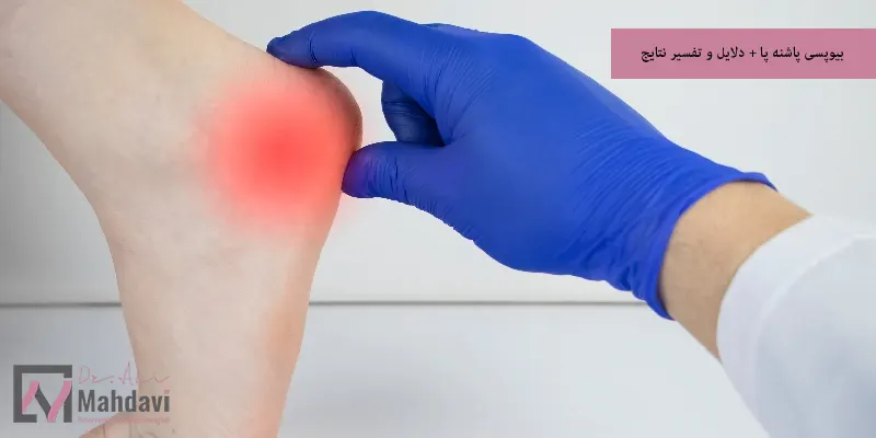 بیوپسی پاشنه پا + دلایل و تفسیر نتایج