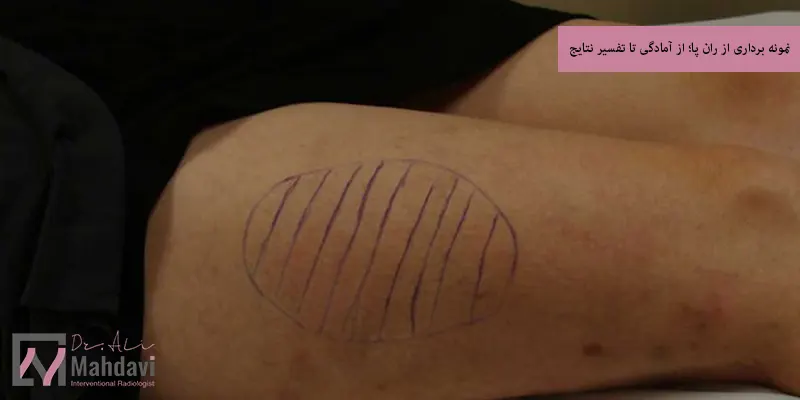 نمونه برداری از ران پا؛ از آمادگی تا تفسیر نتایج