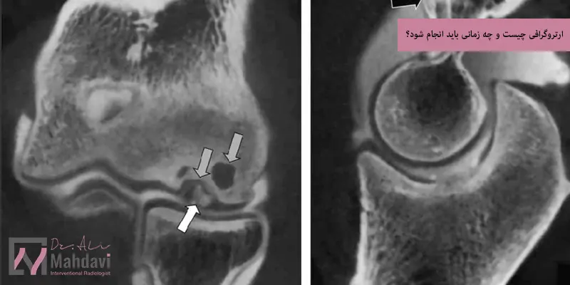 ارتروگرافی چیست و چه زمانی باید انجام شود؟