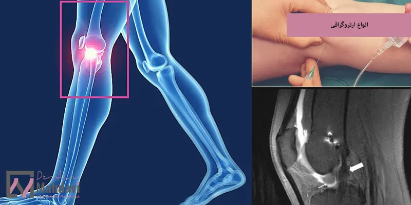 انواع ارتروگرافی