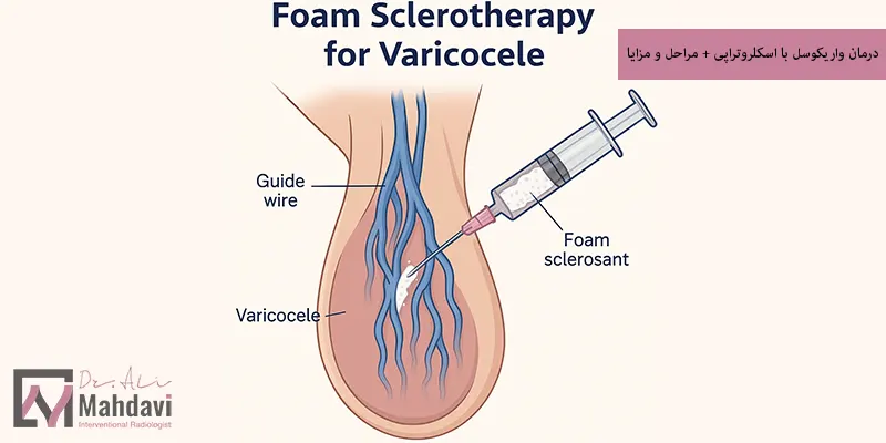 درمان واریکوسل با اسکلروتراپی + مراحل و مزایا