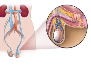 درمان واریکوسل با واسکولار به چه صورت است؟