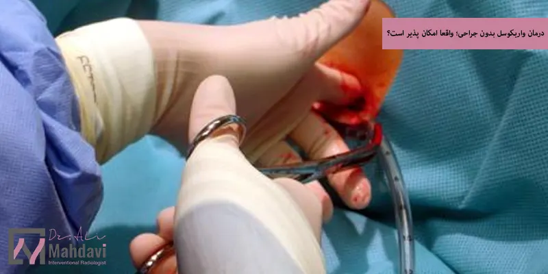 درمان واریکوسل بدون جراحی؛ واقعا امکان پذیر است؟