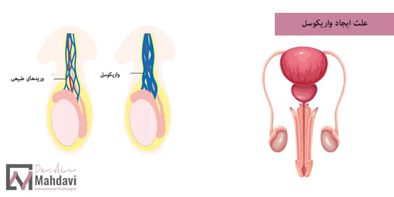 علت ایجاد واریکوسل