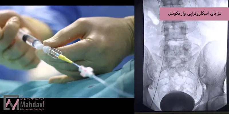 مزایای اسکلروتراپی واریکوسل