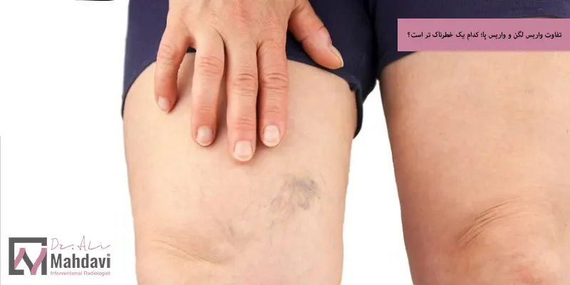 تفاوت واریس لگن و واریس پا؛ کدام یک خطرناک تر است؟