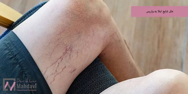 علل شایع ابتلا به واریس