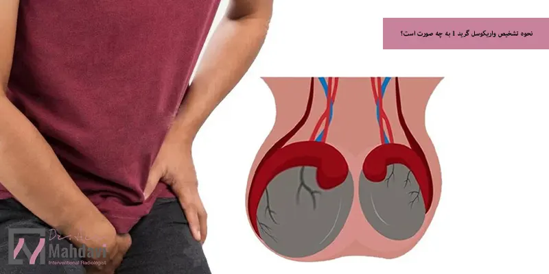 نحوه تشخیص واریکوسل گرید 1 به چه صورت است؟