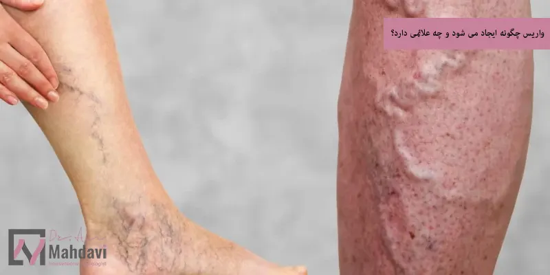 واریس چگونه ایجاد می شود و چه علائمی دارد؟