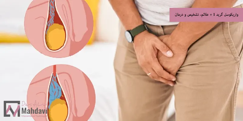 واریکوسل گرید 1 + علائم، تشخیص و درمان